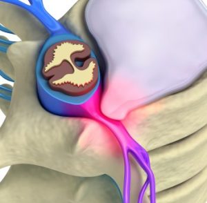 degenerative disk disease leads to pain