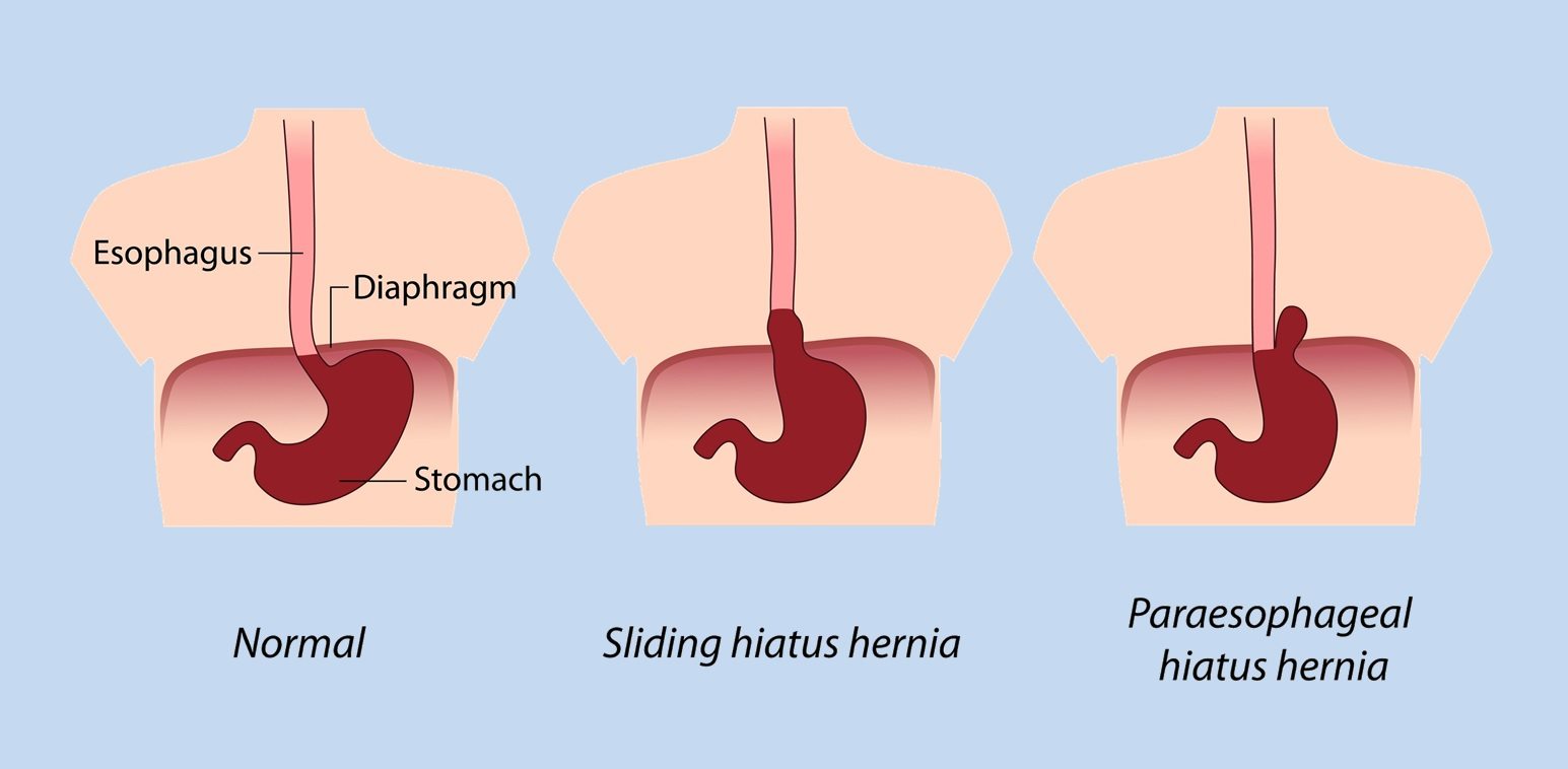 Cincinnati Ohio Hiatal Hernia Relief Symptoms Hiatus